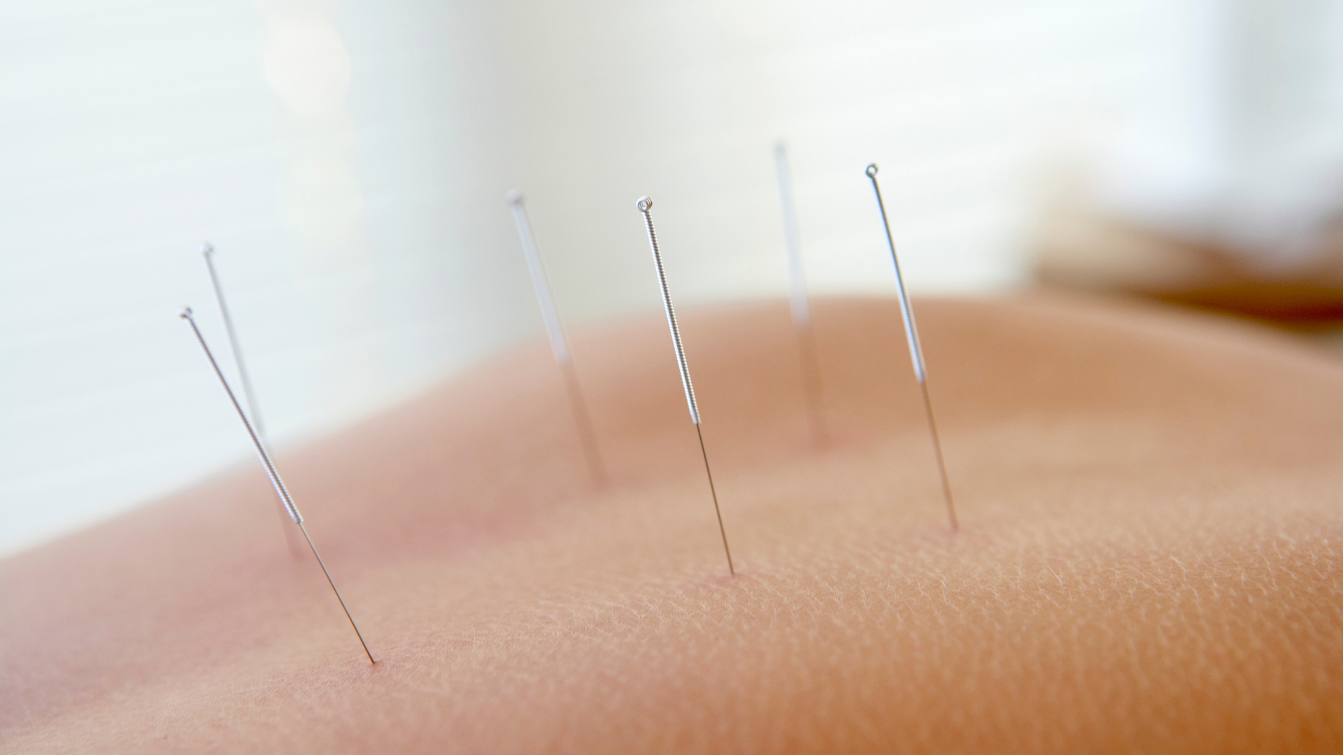 acupuncture